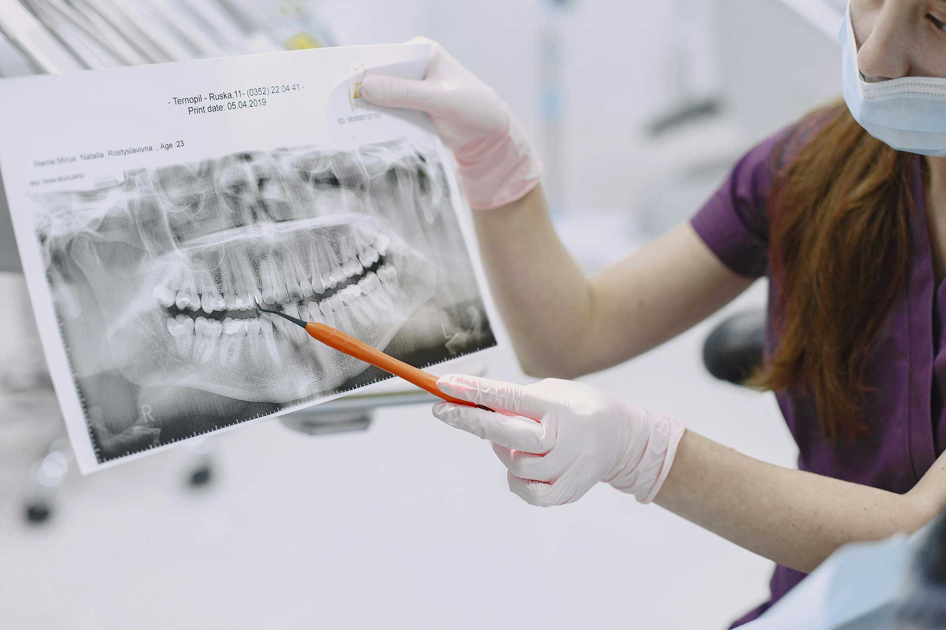 Partial Dentures in Irvine, CA Dental Dentures