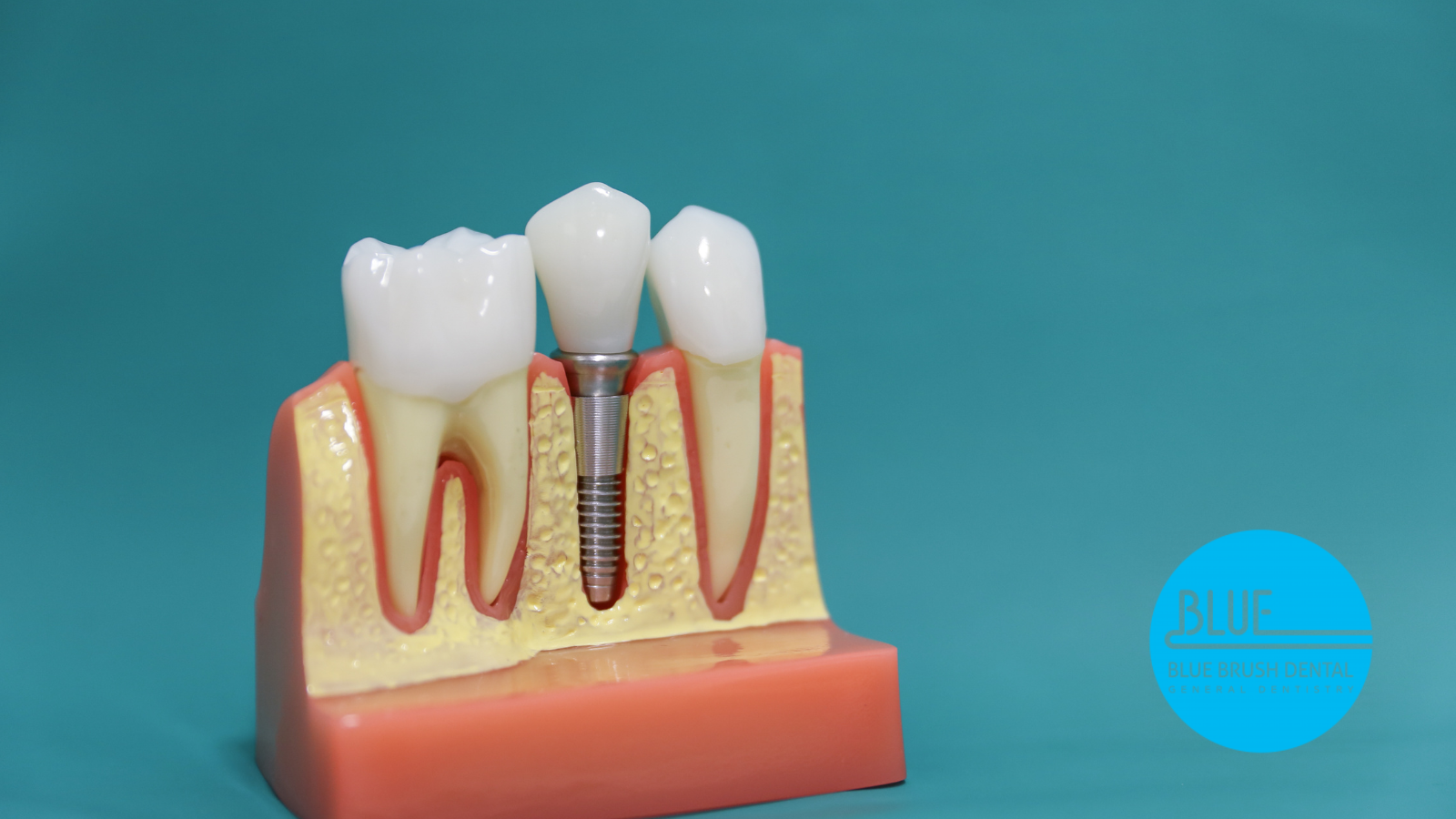 How Long Do Dental Implants Last?