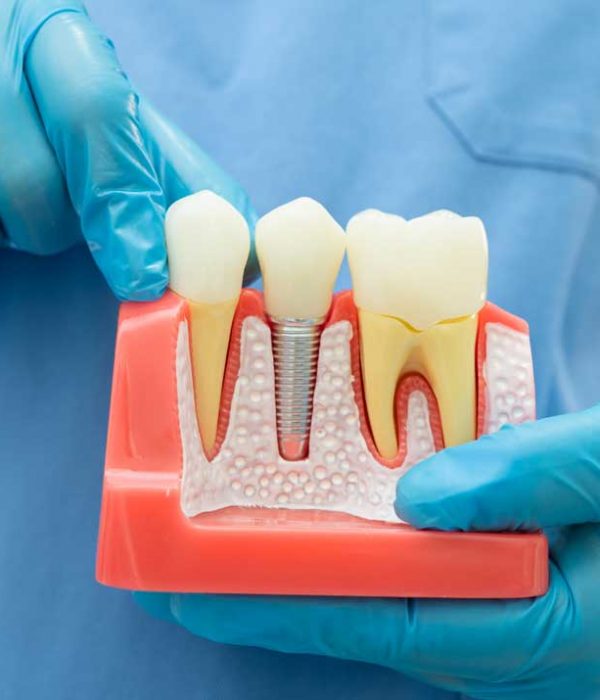 Teeth model featuring a prominent dental implant on the lower portion, emphasizing dental restoration